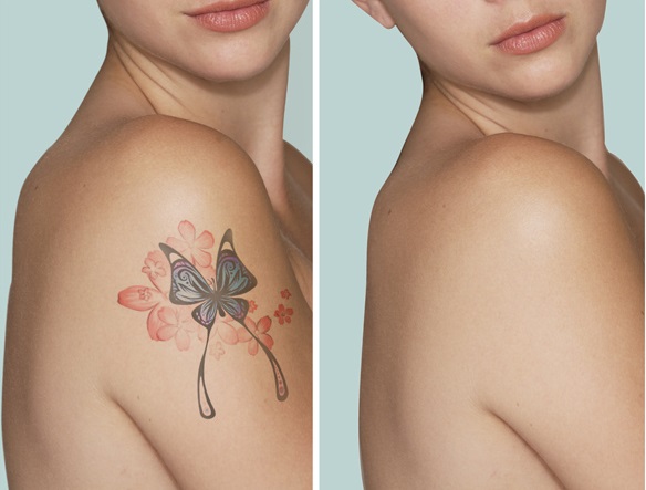 kết quả làm máy xóa xăm laser yag light spectra truoc va sau khi xoa 2.jpg (76 KB)